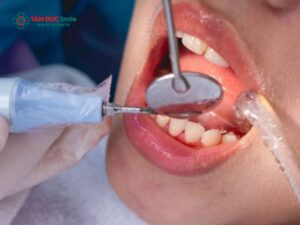 Răng ố vàng và có cao răng: Nguyên nhân, phương pháp điều trị và cách ngăn ngừa