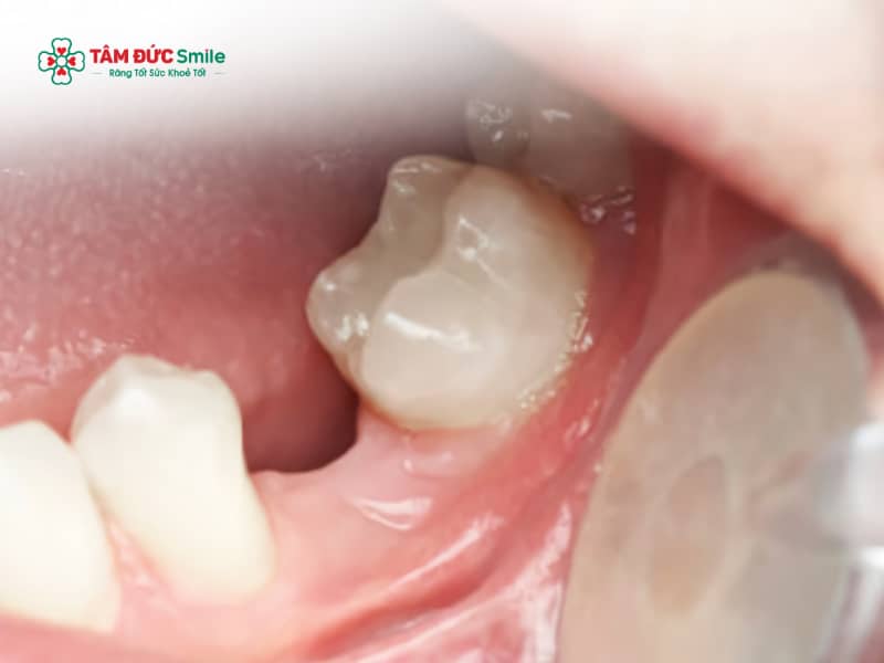Răng số 5 là răng gì? Vị trí, chức năng, cấu tạo và cách điều trị hiệu quả