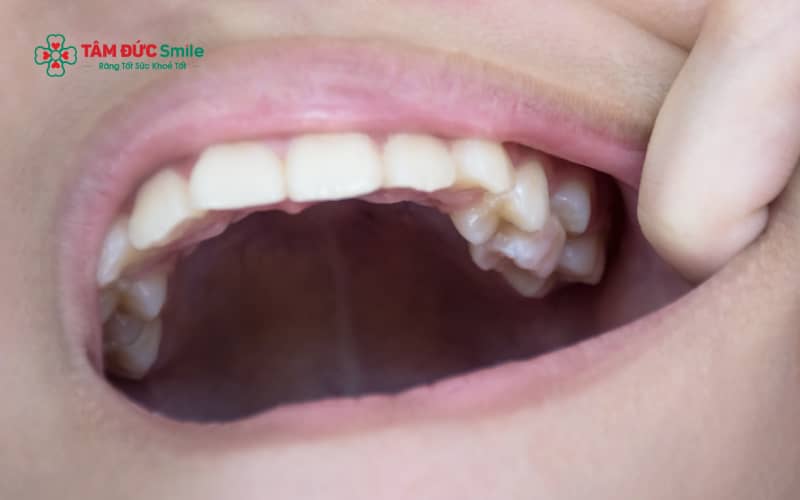Răng số 8 thường mọc lệch do thiếu khoảng trống trên cung hàm, cấu trúc xương hàm nhỏ, hẹp hoặc quá trình phát triển răng không bình thường.
