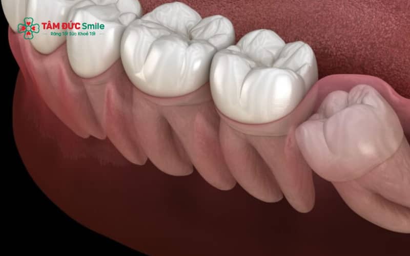 Răng số 8 mọc lệch có thể gây đau nhức kéo dài, viêm nhiễm tái phát và làm tổn thương nghiêm trọng răng số 7 nếu không được xử lý kịp thời