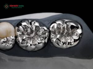 Răng sứ chrome cobalt là gì? Ưu nhược điểm và lưu ý chăm sóc sau khi bọc răng sứ chrome cobalt