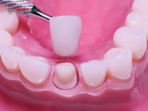 Răng sứ đắt nhất hiện nay: Các dòng răng sứ cao cấp, đẹp tự nhiên, bền vượt trội