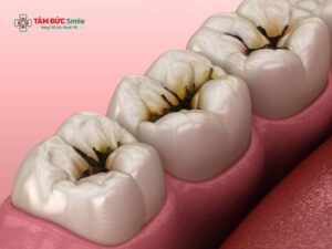 Sâu men răng là gì? Nguyên nhân, cách điều trị và phòng ngừa