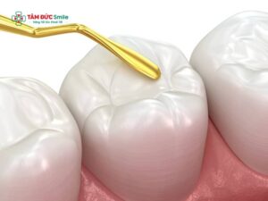 Trám răng mất bao lâu? Thời gian trám răng, trám răng sâu mất bao nhiêu phút