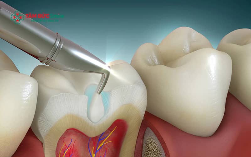 Mức độ răng sâu quyết định trực tiếp việc có cần lấy tủy hay không, từ trám đơn giản đến điều trị tủy chuyên sâu
