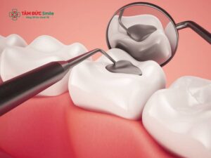Trám răng sâu có lấy tủy không? Khi nào cần chữa tủy, khi nào chỉ cần trám