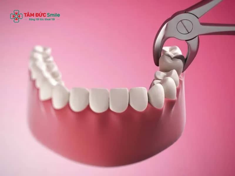 Trước khi nhổ răng nên làm gì để an toàn, hạn chế đau và biến chứng
