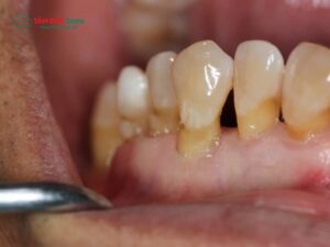 Tụt nướu răng là gì? Nguyên nhân, dấu hiệu và cách điều trị hiệu quả