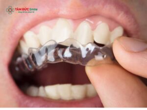 Ưu điểm của niềng răng Invisalign: thẩm mỹ, hiệu quả, ít đau, tháo lắp linh hoạt
