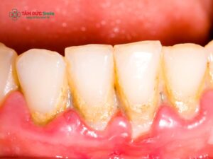 Viêm quanh cuống răng: Nguyên nhân, triệu chứng và cách điều trị hiệu quả