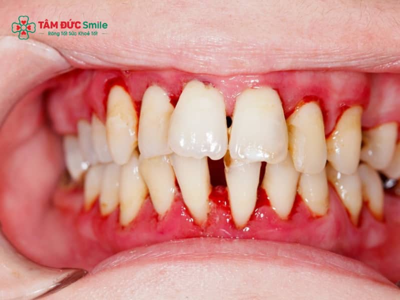 Biến chứng niềng răng: Tiêu chân răng, viêm lợi, sai khớp cắn