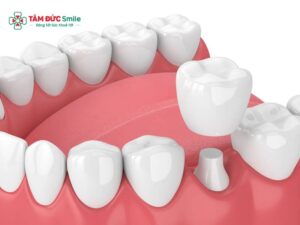 Bọc răng sứ bị mỏi hàm: Sai khớp cắn, răng sứ cao, cách xử lý