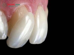 Tình trạng bọc răng sứ bị ngứa, ngứa nướu sau khi bọc răng sứ khiến nhiều người lo lắng về dị ứng mão răng sứ, răng sứ kim loại gây kích ứng hoặc viêm lợi quanh răng sứ. Nguyên nhân thường do lắp mão sứ không sát khít, kỹ thuật mài răng sai cách hoặc chăm sóc chưa đúng. Thời gian thích nghi thường 3–7 ngày, nhưng nếu kèm hôi miệng, sưng đỏ, cần kiểm tra sớm. Tại Nha khoa Tâm Đức Smile, bác sĩ đánh giá chính xác, điều chỉnh hoặc thay mão sứ toàn sứ zirconia an toàn, độ bền 5–15 năm. 1. Nguyên nhân bọc răng sứ bị ngứa thường gặp Tình trạng bọc răng sứ bị ngứa là vấn đề không hiếm gặp sau khi phục hình răng thẩm mỹ. Một số người sau khi hoàn tất quá trình bọc răng có thể xuất hiện cảm giác ngứa nướu sau khi bọc răng sứ, khó chịu quanh lợi hoặc cảm giác cộm nhẹ khi ăn nhai. Trong nhiều trường hợp, đây chỉ là phản ứng thích nghi tự nhiên của mô nướu với mão răng sứ mới. Tuy nhiên nếu tình trạng này kéo dài, rất có thể xuất phát từ một số nguyên nhân liên quan đến kỹ thuật nha khoa, vật liệu phục hình hoặc cách chăm sóc răng miệng. Việc xác định đúng nguyên nhân giúp bác sĩ đưa ra hướng xử lý phù hợp, hạn chế các biến chứng như viêm lợi quanh răng sứ, răng sứ bị viêm nha chu hay tình trạng bọc răng sứ bị hôi miệng. 1.1 Dị ứng vật liệu mão răng sứ Một trong những nguyên nhân phổ biến dẫn đến bọc răng sứ bị ngứa là phản ứng dị ứng với vật liệu phục hình. Một số loại răng sứ kim loại sử dụng hợp kim trong cấu tạo mão răng. Với những người có cơ địa nhạy cảm, các kim loại này có thể gây kích ứng mô nướu. Khi xảy ra phản ứng dị ứng, người bệnh có thể cảm thấy ngứa nướu sau khi bọc răng sứ, kèm theo biểu hiện sưng nhẹ hoặc đỏ lợi. Trong một số trường hợp, tình trạng răng sứ kim loại gây kích ứng còn khiến người bệnh cảm thấy nóng rát vùng lợi hoặc có cảm giác khó chịu khi ăn uống. Để hạn chế nguy cơ này, nhiều nha khoa hiện nay khuyến khích sử dụng mão sứ toàn sứ hoặc vật liệu zirconia. Những vật liệu này có độ tương thích sinh học cao, ít gây kích ứng nướu và mang lại tính thẩm mỹ tốt hơn. 1.2 Mão sứ lắp không sát khít Một nguyên nhân quan trọng khác gây bọc răng sứ bị ngứa là tình trạng lắp mão sứ không sát khít với cùi răng thật. Khi mão sứ không ôm sát răng, khe hở nhỏ sẽ xuất hiện giữa răng và mão sứ. Khe hở này tạo điều kiện để thức ăn và vi khuẩn tích tụ. Theo thời gian, mảng bám hình thành quanh chân răng và gây viêm lợi. Khi đó, người bệnh có thể gặp tình trạng viêm lợi quanh răng sứ, cảm giác ngứa, khó chịu hoặc thậm chí xuất hiện bọc răng sứ bị hôi miệng. Ngoài ra, mão răng không khít còn khiến người bệnh cảm thấy bọc răng sứ bị cộm khi ăn nhai. Nếu không được điều chỉnh kịp thời, vi khuẩn có thể xâm nhập sâu hơn và gây răng sứ bị viêm nha chu, ảnh hưởng đến tuổi thọ của răng phục hình. 1.3 Kỹ thuật mài răng sai cách Quá trình bọc răng sứ luôn bao gồm bước mài nhỏ răng thật để tạo không gian cho mão sứ. Tuy nhiên nếu kỹ thuật mài răng sai cách, việc mài răng quá nhiều hoặc xâm lấn mô nướu có thể gây tổn thương lợi. Khi mô nướu bị kích thích, người bệnh dễ xuất hiện cảm giác ngứa nướu sau khi bọc răng sứ, kèm theo dấu hiệu sưng hoặc chảy máu nhẹ. Trong trường hợp nghiêm trọng hơn, vùng lợi quanh mão răng sứ có thể bị viêm kéo dài. Do đó, quá trình mài răng đòi hỏi bác sĩ phải có kinh nghiệm và thực hiện đúng kỹ thuật để đảm bảo tỷ lệ mài răng phù hợp, vừa bảo vệ răng thật vừa giúp mão sứ ôm sát răng. 1.4 Vệ sinh răng miệng chưa đúng cách Sau khi phục hình răng, nếu người bệnh không chú ý đến chăm sóc răng sứ sau khi bọc, mảng bám và vi khuẩn rất dễ tích tụ quanh vùng lợi. Mảng bám lâu ngày có thể gây kích ứng nướu, dẫn đến ngứa nướu sau khi bọc răng sứ hoặc viêm lợi. Ngoài ra, tình trạng vệ sinh kém còn làm tăng nguy cơ bọc răng sứ bị hôi miệng, khiến hơi thở có mùi khó chịu. Nếu không được làm sạch kịp thời, vi khuẩn có thể lan xuống vùng nha chu và gây răng sứ bị viêm nha chu, ảnh hưởng trực tiếp đến độ bền của phục hình. 2. Cách xử lý khi bọc răng sứ bị ngứa hiệu quả Khi xuất hiện tình trạng bọc răng sứ bị ngứa, người bệnh không nên tự ý xử lý tại nhà mà nên đến nha khoa để được kiểm tra chính xác. Tùy vào nguyên nhân cụ thể, bác sĩ sẽ đưa ra phương pháp điều trị phù hợp nhằm khắc phục tình trạng kích ứng nướu và bảo vệ răng phục hình. 2.1 Tái khám kiểm tra mão răng sứ Việc đầu tiên cần làm khi gặp tình trạng ngứa nướu sau khi bọc răng sứ là tái khám để kiểm tra tình trạng của mão răng sứ. Bác sĩ sẽ đánh giá các yếu tố như: Độ sát khít của mão sứ Vị trí tiếp xúc giữa mão sứ và nướu Tình trạng khớp cắn khi ăn nhai Nếu phát hiện lắp mão sứ không sát khít, bác sĩ sẽ điều chỉnh hoặc gắn lại mão răng để đảm bảo răng phục hình ôm sát cùi răng thật. 2.2 Thay vật liệu răng sứ phù hợp Trong trường hợp răng sứ kim loại gây kích ứng, bác sĩ có thể khuyến nghị thay mão răng bằng vật liệu an toàn hơn như mão sứ toàn sứ hoặc zirconia. Những loại vật liệu này có ưu điểm: Độ tương thích sinh học cao Ít gây dị ứng nướu Thẩm mỹ tự nhiên giống răng thật Hạn chế tình trạng viêm lợi quanh răng sứ Việc thay vật liệu phù hợp giúp giảm nhanh tình trạng bọc răng sứ bị ngứa và cải thiện sức khỏe răng miệng lâu dài. 2.3 Điều trị viêm lợi quanh răng sứ Nếu nguyên nhân ngứa xuất phát từ viêm lợi quanh răng sứ, bác sĩ sẽ tiến hành làm sạch mảng bám và điều trị viêm. Quy trình thường bao gồm: Vệ sinh răng chuyên sâu Loại bỏ vi khuẩn quanh mão răng sứ Hướng dẫn chăm sóc răng sứ sau khi bọc Trong những trường hợp nặng, việc điều trị răng sứ bị viêm nha chu có thể cần thêm thuốc hoặc điều trị nha chu chuyên sâu để bảo vệ răng thật bên trong. 3. Phòng tránh tình trạng bọc răng sứ bị ngứa Phòng tránh luôn là yếu tố quan trọng giúp hạn chế các biến chứng sau khi phục hình răng. Nếu được thực hiện đúng quy trình và chăm sóc tốt, nguy cơ bọc răng sứ bị ngứa có thể giảm đáng kể. 3.1 Lựa chọn vật liệu răng sứ chất lượng Vật liệu phục hình đóng vai trò quan trọng trong việc hạn chế kích ứng nướu. Hiện nay, nhiều nha khoa khuyến khích sử dụng mão sứ toàn sứ hoặc zirconia vì khả năng tương thích sinh học cao. So với răng sứ kim loại, các loại sứ toàn sứ ít gây dị ứng và giúp giảm nguy cơ ngứa nướu sau khi bọc răng sứ. 3.2 Thực hiện tại nha khoa uy tín Kỹ thuật phục hình quyết định phần lớn sự thành công của quá trình bọc răng. Khi thực hiện tại nha khoa uy tín, bác sĩ sẽ đảm bảo: Kỹ thuật mài răng chuẩn tỷ lệ Lấy dấu răng chính xác Chế tác mão răng sứ phù hợp với khớp cắn Nhờ đó, mão sứ lắp sát khít, hạn chế nguy cơ viêm lợi quanh răng sứ và giúp răng phục hình có độ bền 5–15 năm. 3.3 Chăm sóc răng sứ đúng cách Sau khi bọc răng, người bệnh cần duy trì thói quen chăm sóc răng miệng khoa học để tránh tình trạng bọc răng sứ bị ngứa. Một số nguyên tắc quan trọng gồm: Đánh răng ít nhất 2 lần mỗi ngày Sử dụng chỉ nha khoa để làm sạch quanh mão răng sứ Hạn chế thực phẩm quá cứng hoặc quá dính Tái khám nha khoa định kỳ Việc chăm sóc đúng cách không chỉ giúp ngăn ngừa răng sứ bị viêm nha chu mà còn kéo dài tuổi thọ của răng phục hình.
