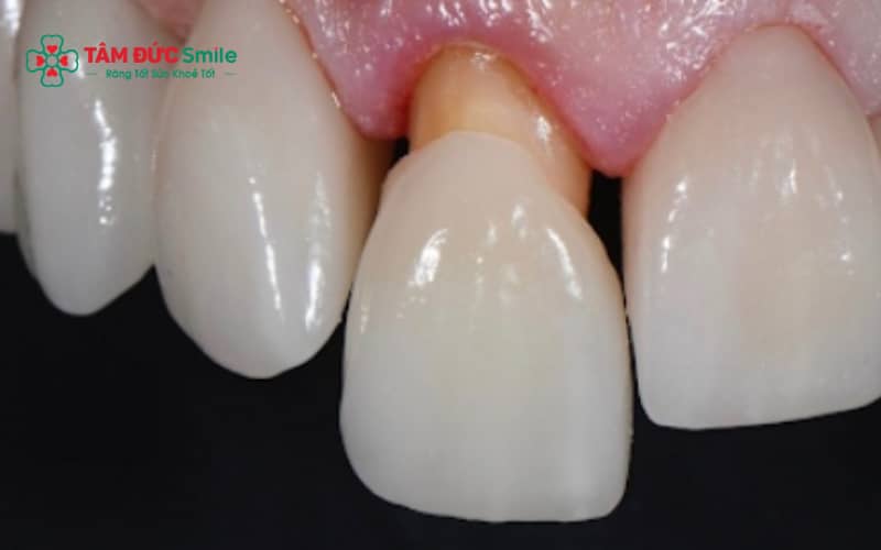 Răng sứ hoàn toàn có thể bị rơi ra nếu kỹ thuật gắn không chuẩn hoặc chăm sóc không đúng cách.