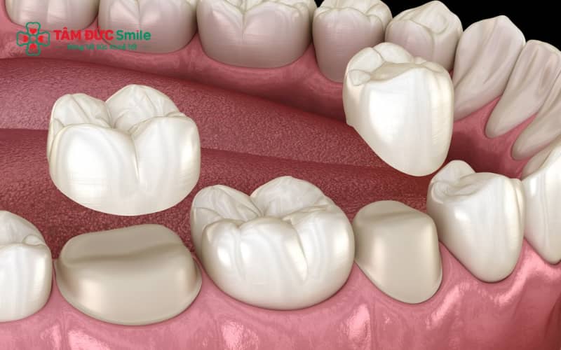 Khi răng sứ bị rớt, cần bảo quản mão sứ và đến nha khoa sớm để được xử lý đúng cách