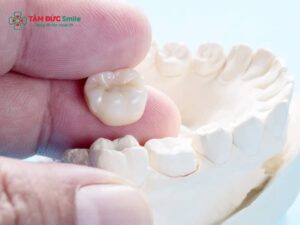 Bọc răng sứ bị rớt ra: nguyên nhân răng sứ bị bung, lỏng và cách xử lý