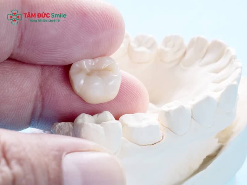 Bọc răng sứ bị rớt ra: nguyên nhân răng sứ bị bung, lỏng và cách xử lý