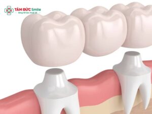 Bọc răng sứ có khó chịu không? Ê buốt bao lâu thì hết?