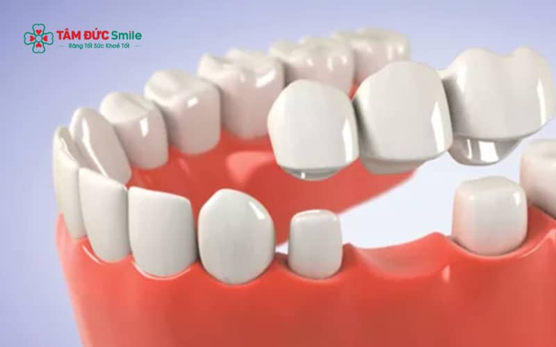 Răng sứ có thể duy trì nhiều năm nếu được phục hình đúng kỹ thuật và chăm sóc đúng cách