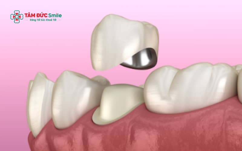 Mỗi loại răng sứ có độ bền và tuổi thọ khác nhau tùy vào vật liệu và công nghệ chế tác