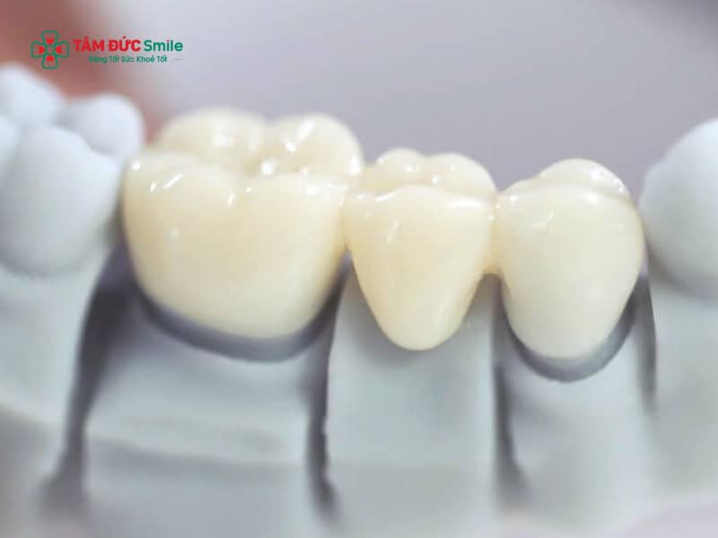 Bọc răng sứ có tuổi thọ bao lâu? Độ bền từng loại răng sứ
