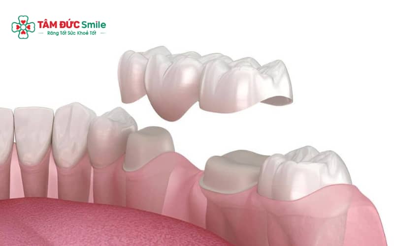 Răng cấm sâu nặng, viêm tủy hoặc vỡ lớn cần bọc răng sứ để bảo vệ cấu trúc răng và khôi phục chức năng ăn nhai