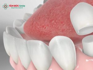 Bọc răng sứ răng cấm: răng số 6, 7 bọc sứ có đau không và bền bao lâu