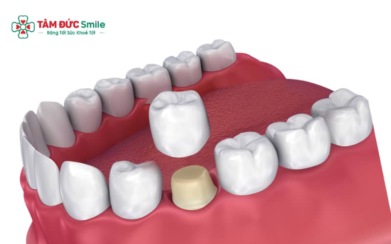 Răng sứ răng hàm có tuổi thọ trung bình 10–15 năm nếu chăm sóc đúng cách và tái khám định kỳ