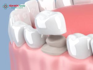 Bọc răng sứ răng thỏ: Tạo hình răng cửa tự nhiên, bền đẹp
