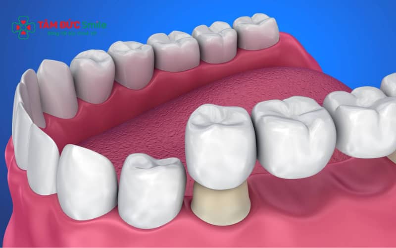 So sánh răng sứ kim loại và toàn sứ sau 10 năm sử dụng, giữ độ bền và thẩm mỹ khác nhau