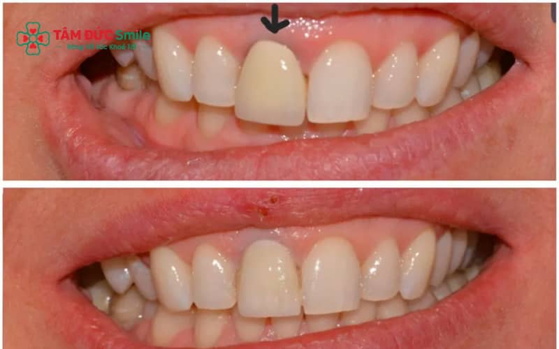 Các vấn đề răng sứ lâu năm: đen viền nướu, hôi miệng, biến chứng nếu không chăm sóc đúng