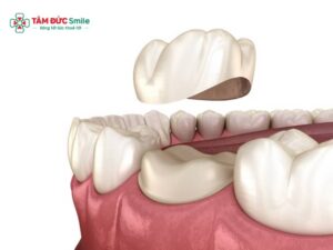 Bọc răng sứ sau 10 năm: Tuổi thọ, biến chứng và có nên thay mới?