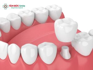 Bọc răng sứ số 6: Mão Zirconia, Cercon bền chắc cho răng hàm
