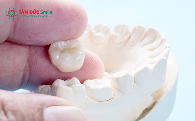 Răng sứ số 7 bền lâu nếu vật liệu tốt, kỹ thuật chính xác và chăm sóc đúng cách