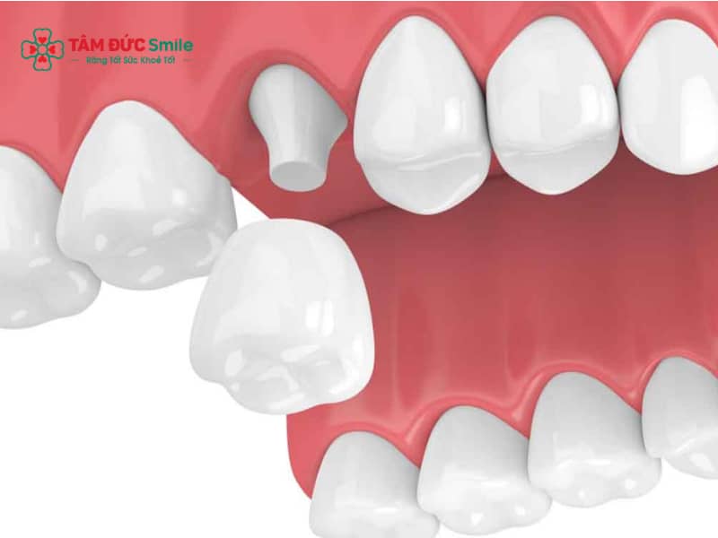 Bọc răng sứ số 7 có nguy hiểm không? Khi nào nên bọc sứ răng hàm