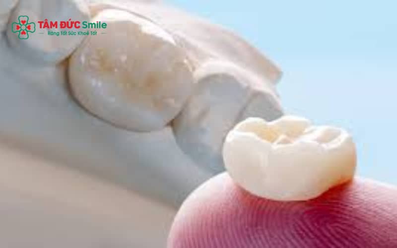 Tuổi thọ răng sứ phụ thuộc chất liệu, kỹ thuật bác sĩ và chế độ vệ sinh, ăn uống hợp lý.