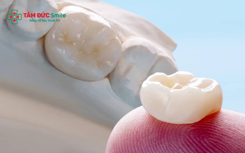 Răng sứ kim loại, Titan và toàn sứ cao cấp, mỗi loại có ưu nhược điểm riêng về thẩm mỹ và độ bền