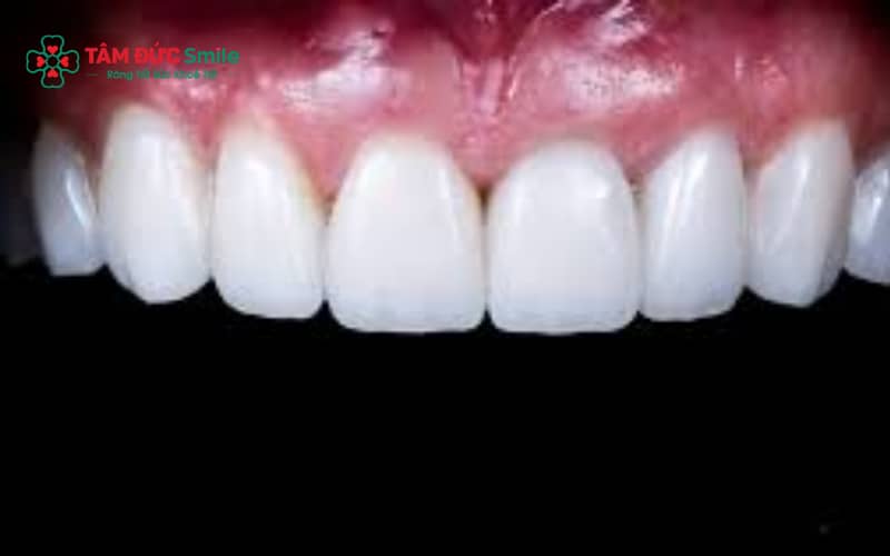 Răng toàn sứ sáng tự nhiên, không đen viền nướu, kim loại bền nhưng thẩm mỹ kém hơn