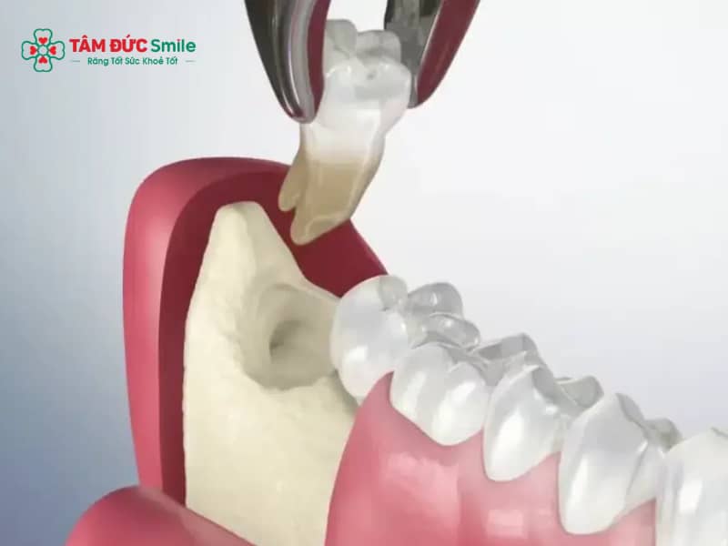 Cho con bú có nhổ được răng khôn? Thuốc tê, giảm đau có an toàn?