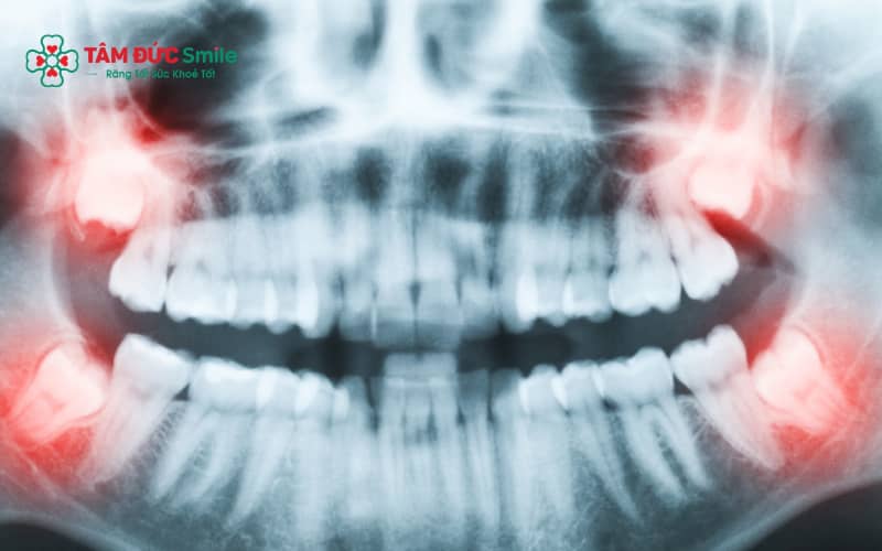 Việc nhổ 4 răng khôn cùng lúc cần dựa trên tình trạng răng và sức khỏe tổng quát của từng bệnh nhân.