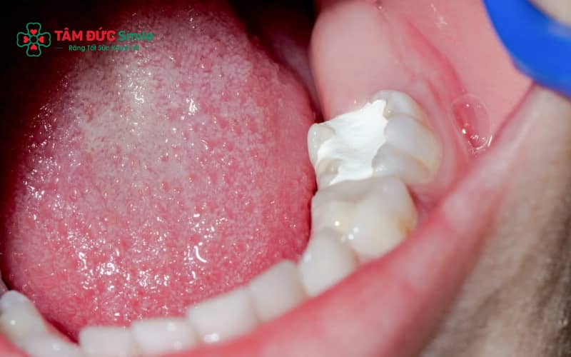 Trám răng giúp phục hồi hình thể và chức năng răng, ngăn ngừa sâu răng tiến triển nặng hơn