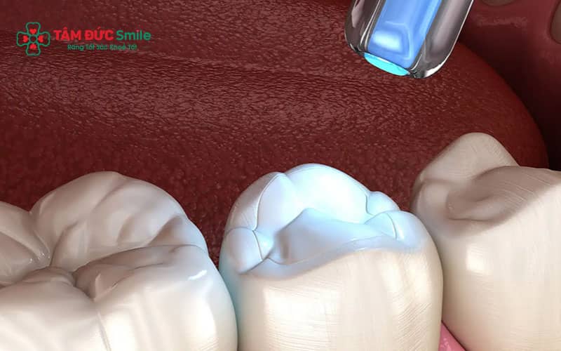Miếng trám răng có thể duy trì nhiều năm tùy vào vật liệu và cách chăm sóc răng miệng
