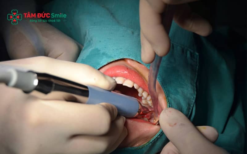 Công nghệ nhổ răng khôn hiện đại như piezotome sử dụng sóng siêu âm giúp tăng độ chính xác và giảm sang chấn