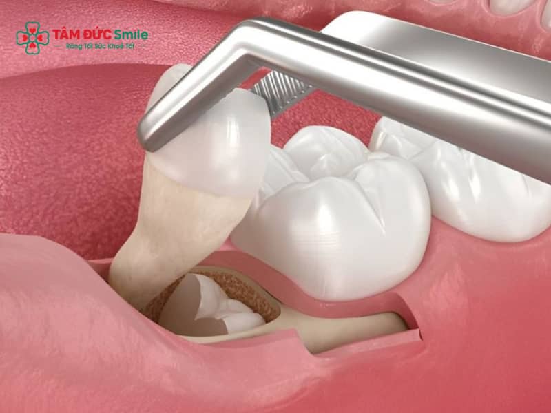 Công nghệ nhổ răng khôn mới nhất bằng sóng siêu âm Piezotome