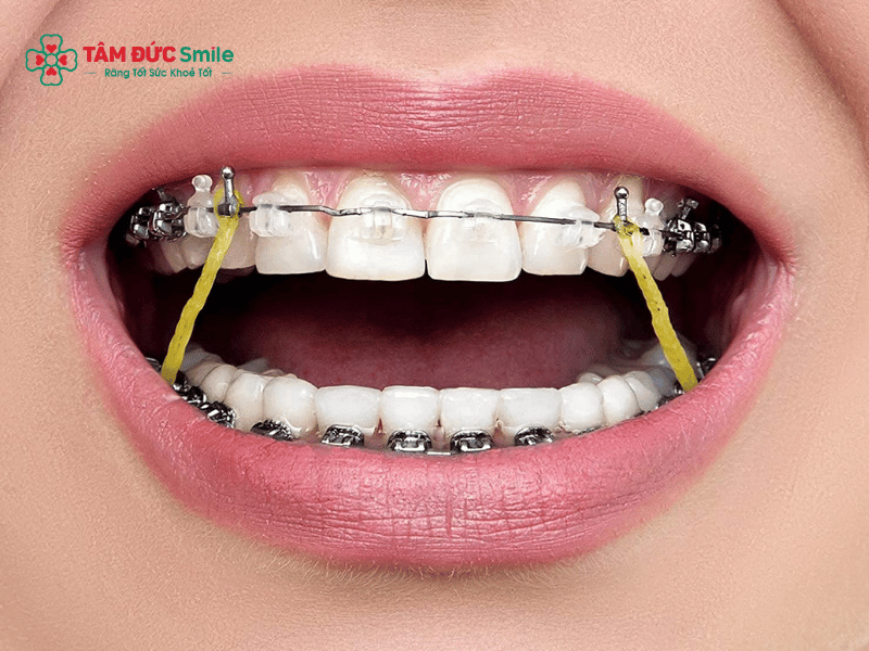 Khi nào nên niềng răng? Độ tuổi lý tưởng và dấu hiệu cần chỉnh nha
