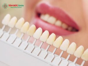 Kinh nghiệm chọn màu răng sứ tự nhiên theo bảng màu Vita chuẩn
