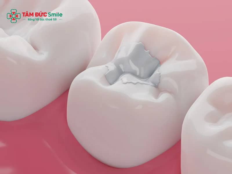 Lợi ích của trám răng: Phục hồi răng sâu, trám răng thẩm mỹ bền đẹp