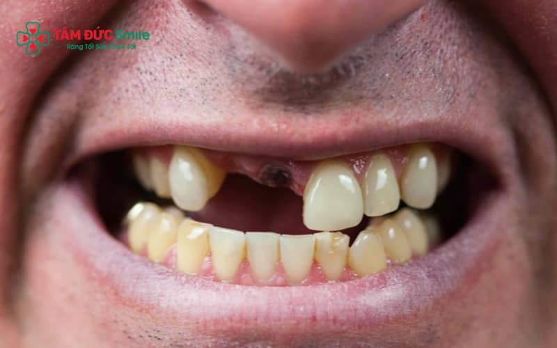 Mất nhiều răng liền kề có thể gây tiêu xương hàm, xô lệch răng và ảnh hưởng nghiêm trọng đến chức năng ăn nhai