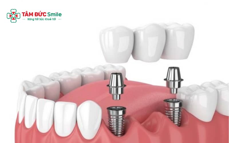 Các phương pháp phục hồi nhiều răng liền kề phổ biến gồm trồng răng Implant, cầu răng sứ và hàm giả tháo lắp