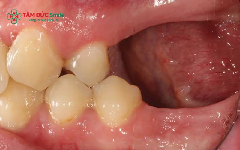 Thăm khám sớm giúp bác sĩ xác định thời điểm phù hợp để trồng lại răng đã mất